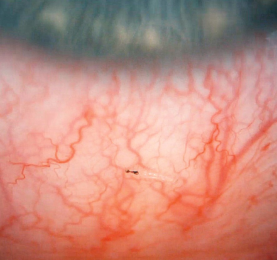 larva oestris ovis v oku člověka